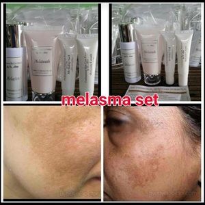 dr alvin melasma set